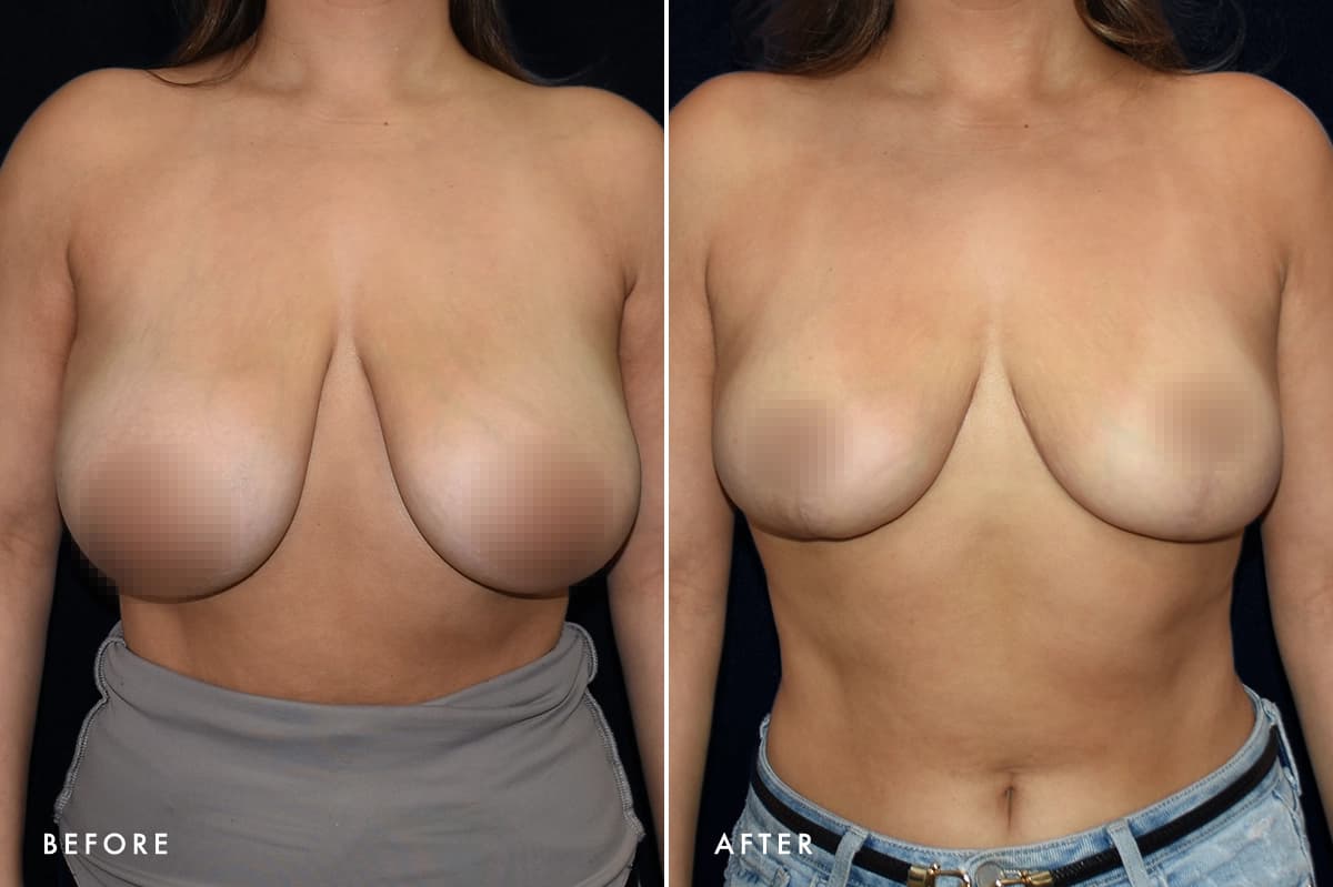pinnacleskin.com /treatments/breast-lift Carousel 3 Image 4