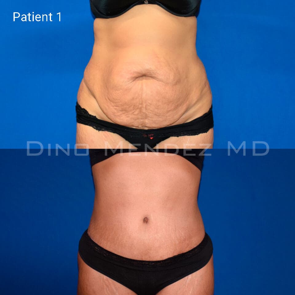 pinnacleskin.com /treatments/tummy-tuck Carousel 2 Image 1