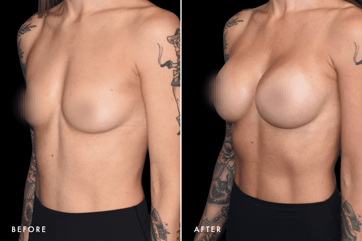 DM Breast Augmentation Gallery — Patient 3 Angle