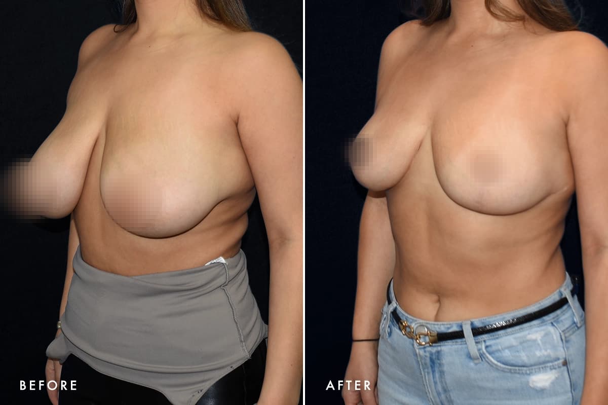 pinnacleskin.com /treatments/breast-lift Carousel 3 Image 5
