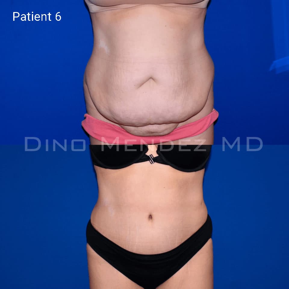 pinnacleskin.com /treatments/tummy-tuck Carousel 3 Image 1