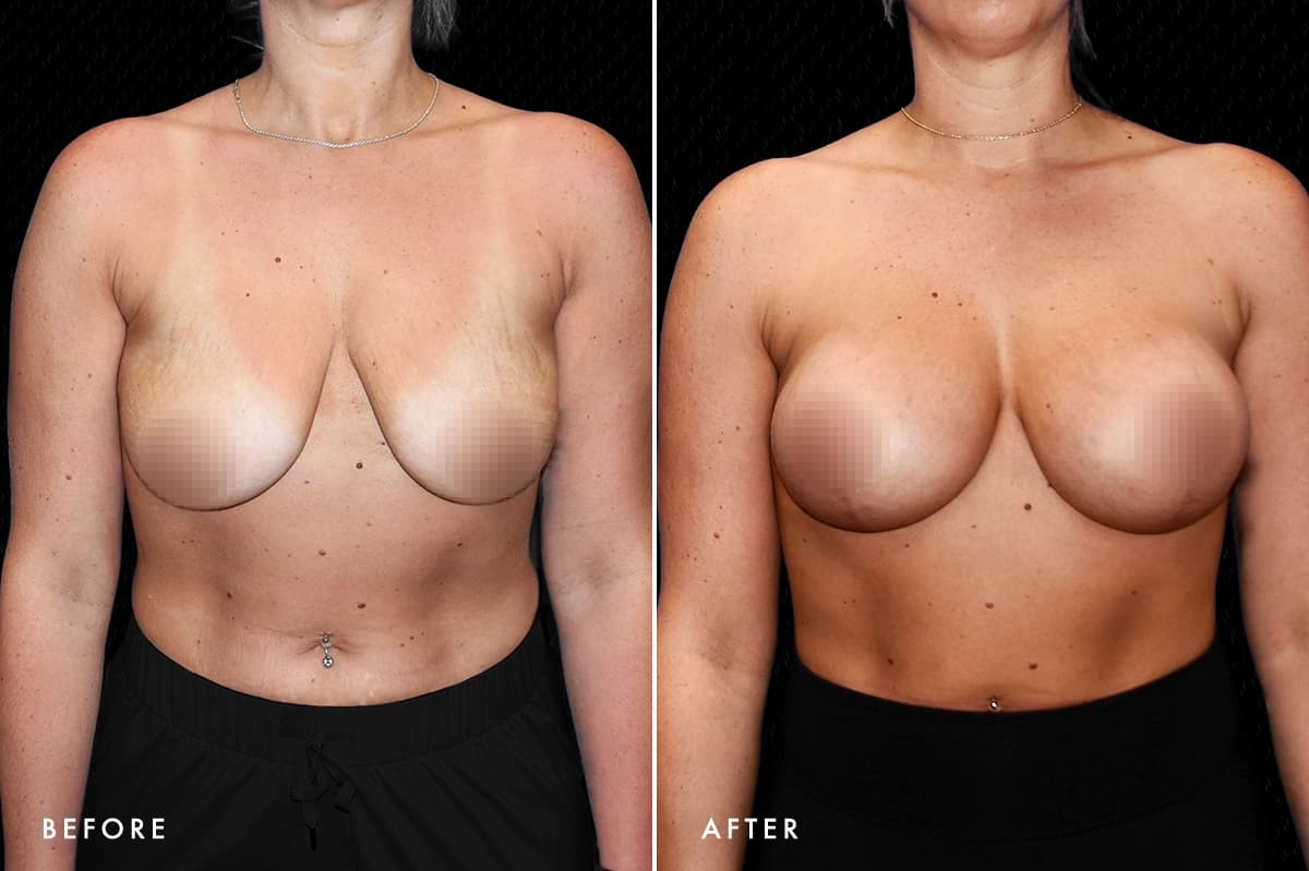 pinnacleskin.com /treatments/breast-lift Carousel 3 Image 1