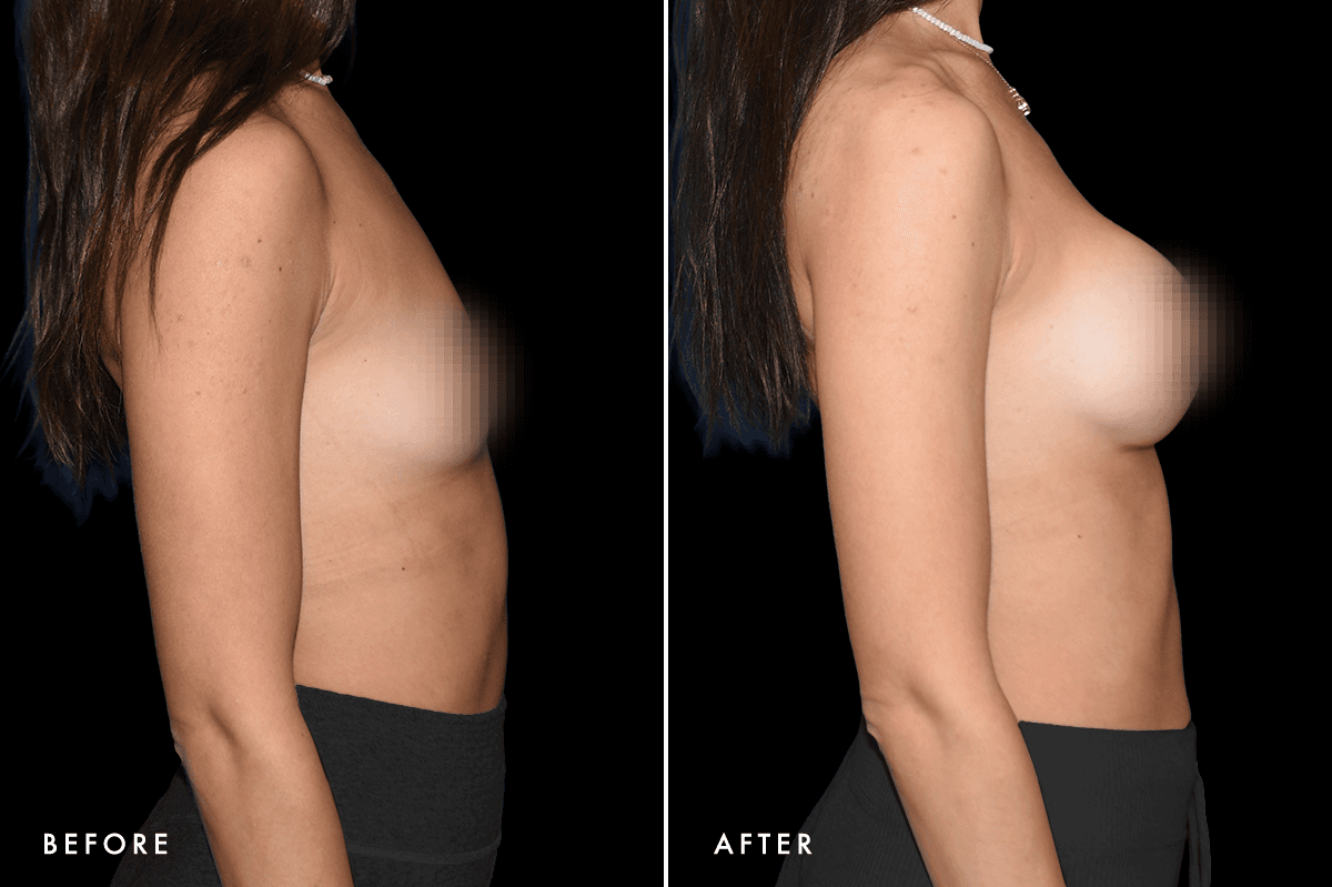 DM Breast Augmentation Gallery — Patient 7 Side