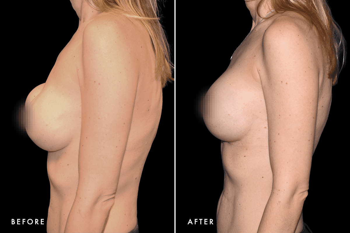 DM Capsular Contracture Correction B&A — Patient 2 Side