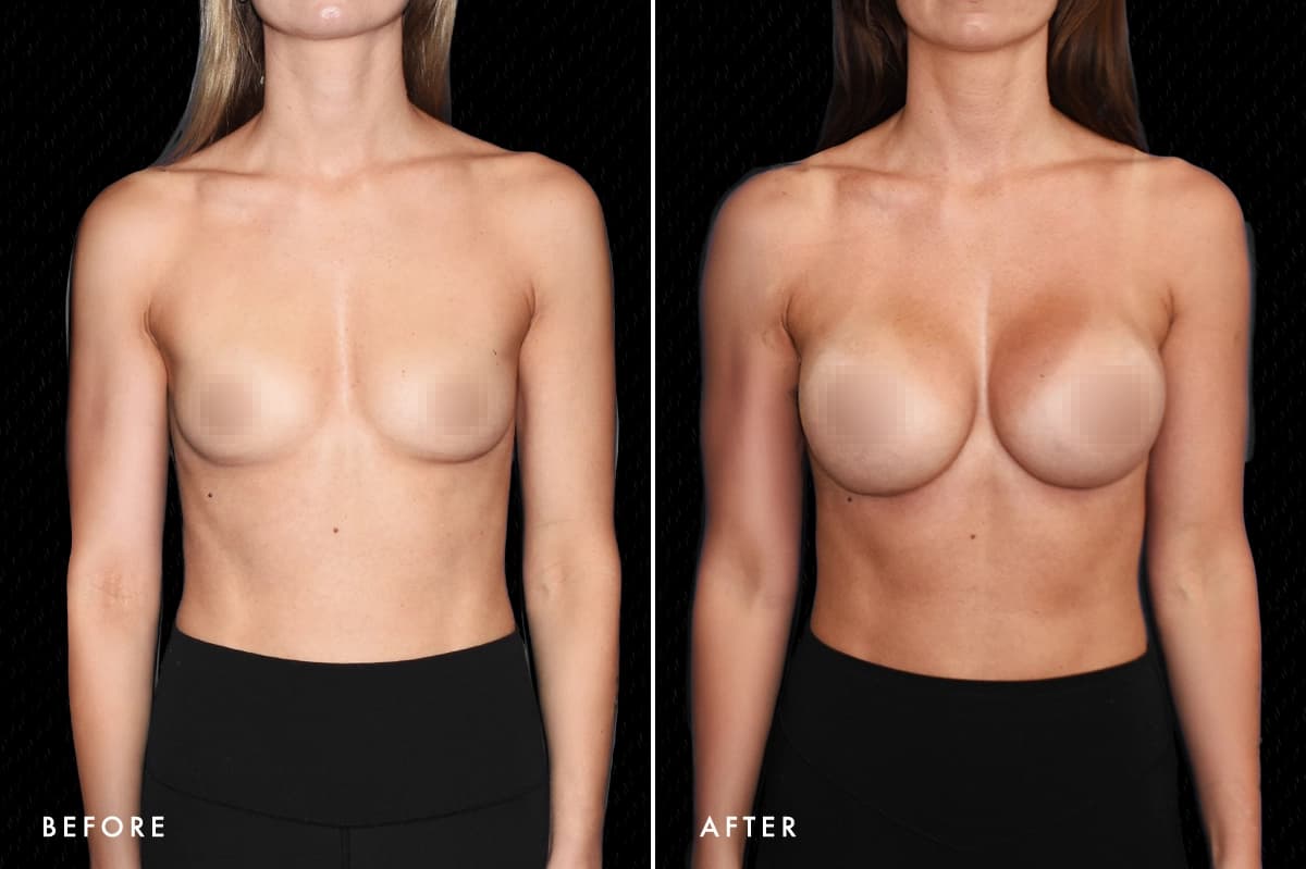 pinnacleskin.com /treatments/breast-augmentation Carousel 3 Image 7