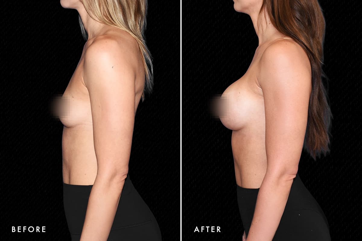 pinnacleskin.com /treatments/breast-augmentation Carousel 3 Image 9