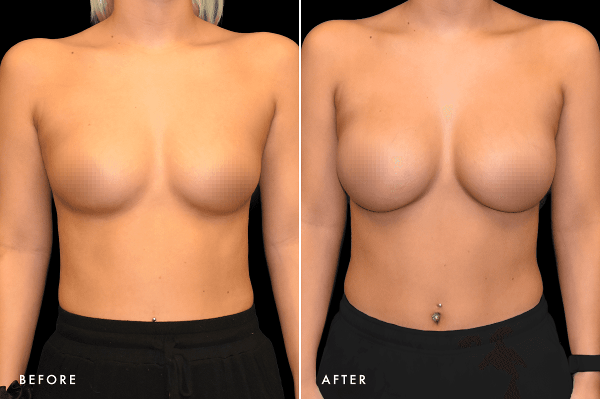 DM Breast Augmentation Gallery — Patient 1 Front