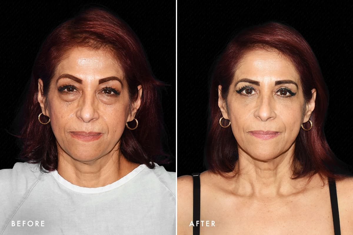 DM Lower Bleph Patient 2 Front Before After