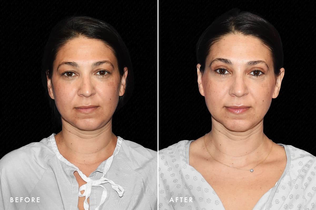DM Upper Bleph Patient 1 Front Before After