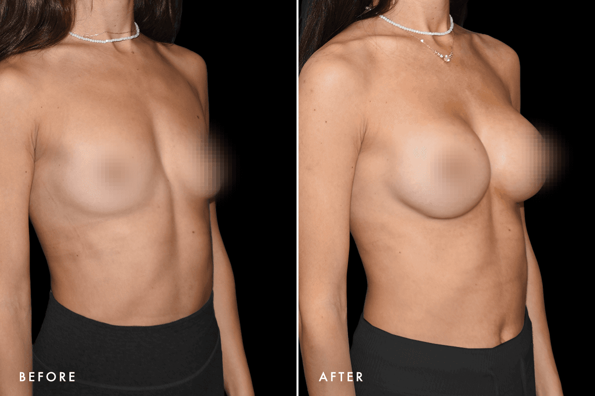 DM Breast Augmentation Gallery — Patient 7 Angle