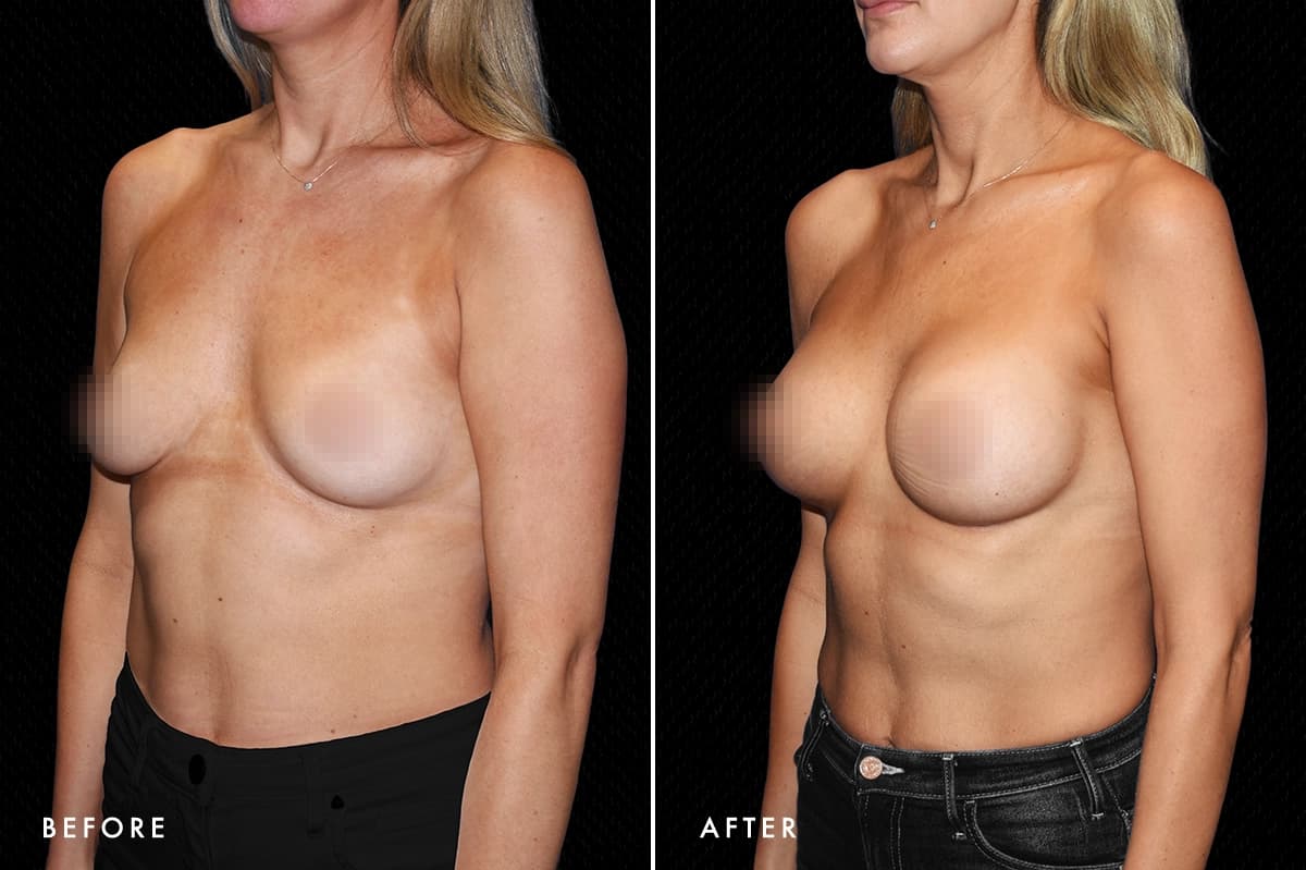 pinnacleskin.com /treatments/breast-augmentation Carousel 3 Image 2