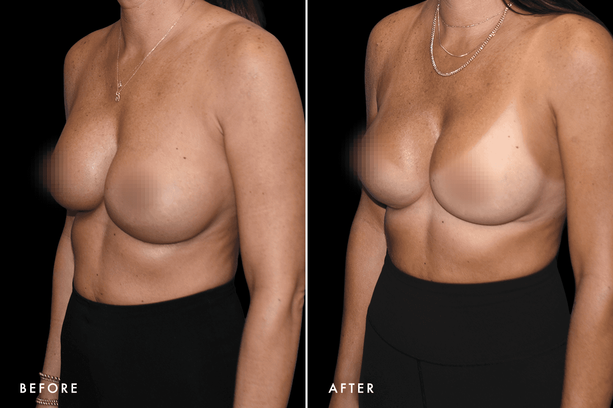 DM Capsular Contracture Correction B&A — Patient 1 Angle