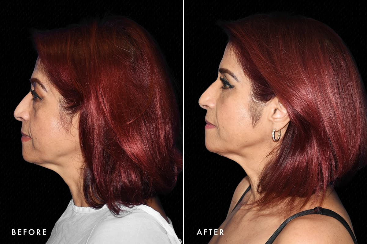 DM Lower Bleph Patient 2 Profile Before After