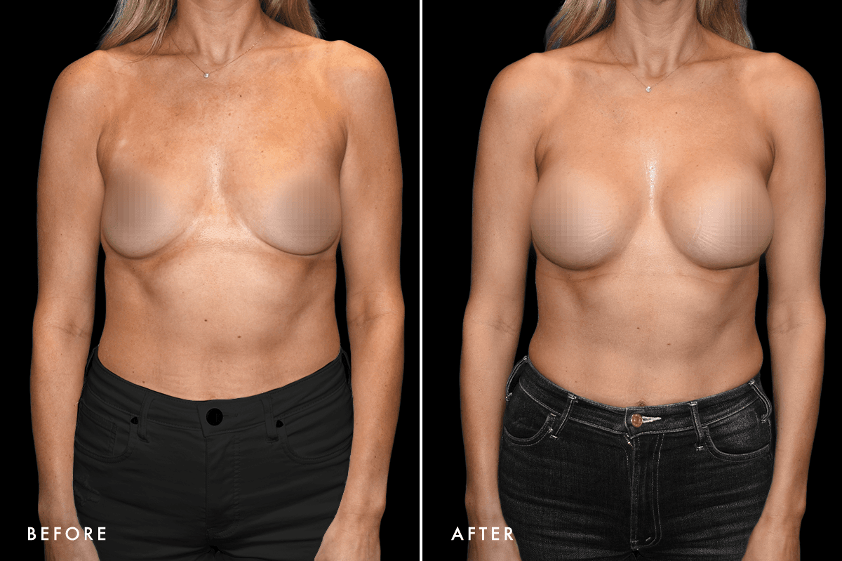 DM Breast Augmentation Gallery — Patient 9 Front