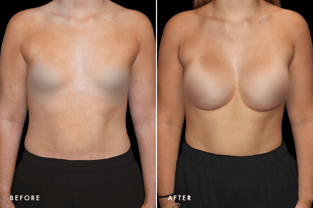 DM Tuberous Breast Correction B&A — Patient 1 Front