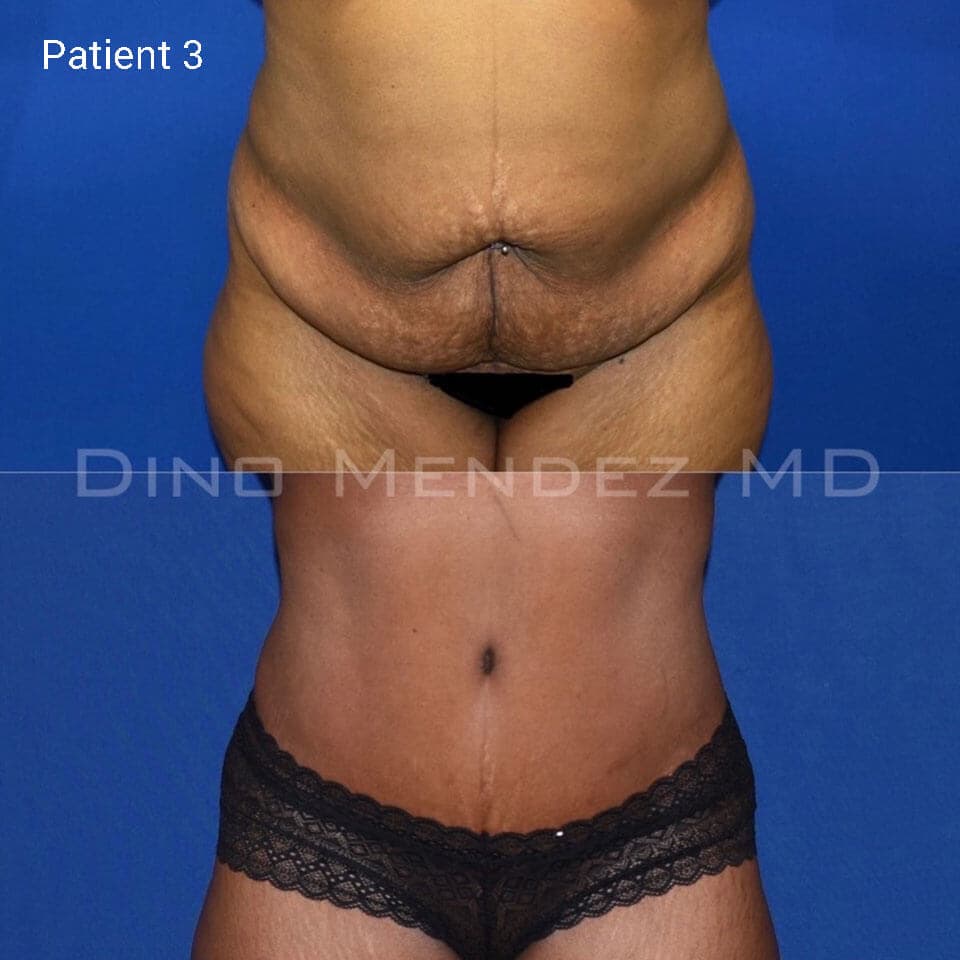 pinnacleskin.com /treatments/tummy-tuck Carousel 2 Image 5