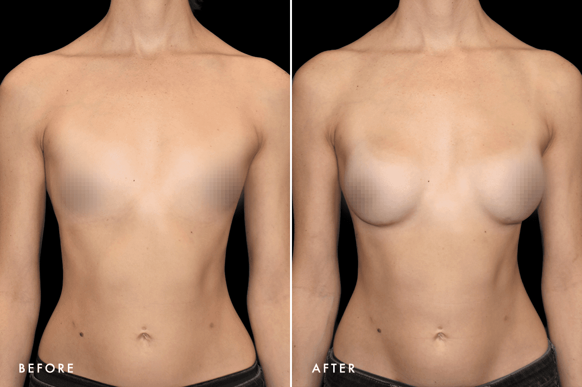 DM Ballerina Breast Augmentation B&A — Patient 2 Front