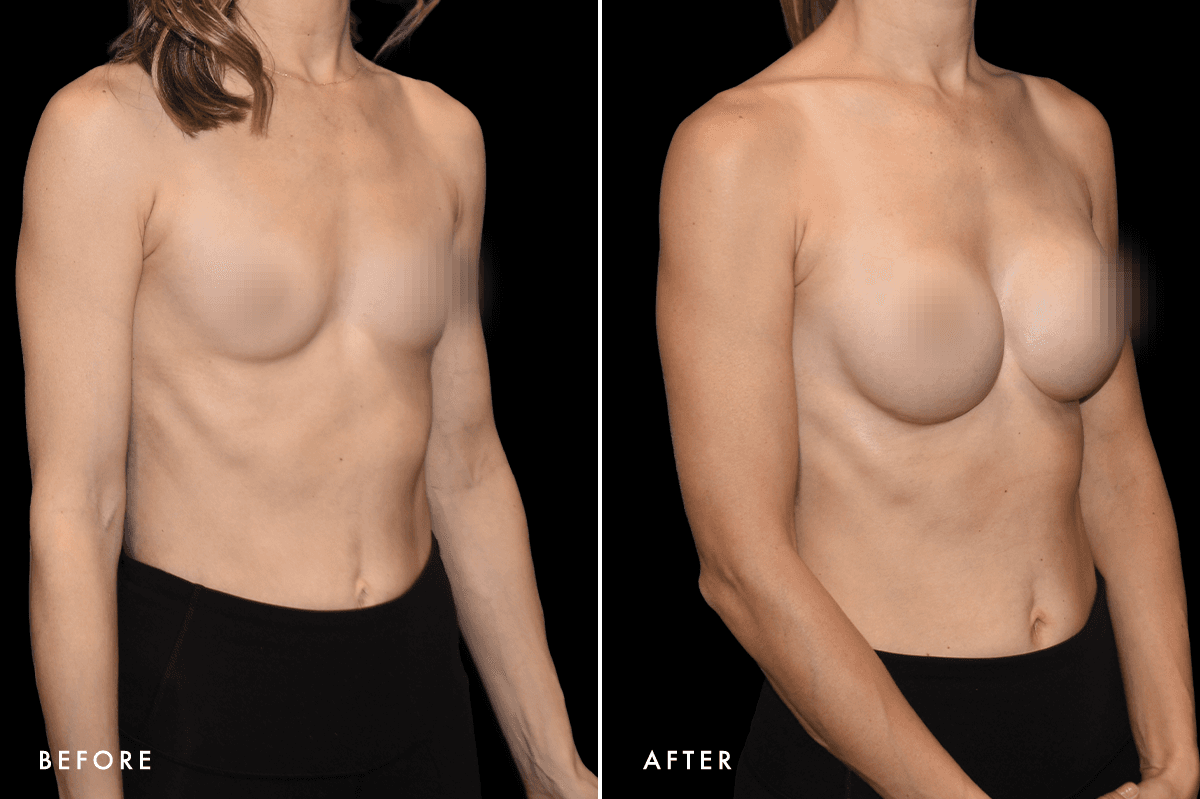 DM Ballerina Breast Augmentation B&A — Patient 3 Angle