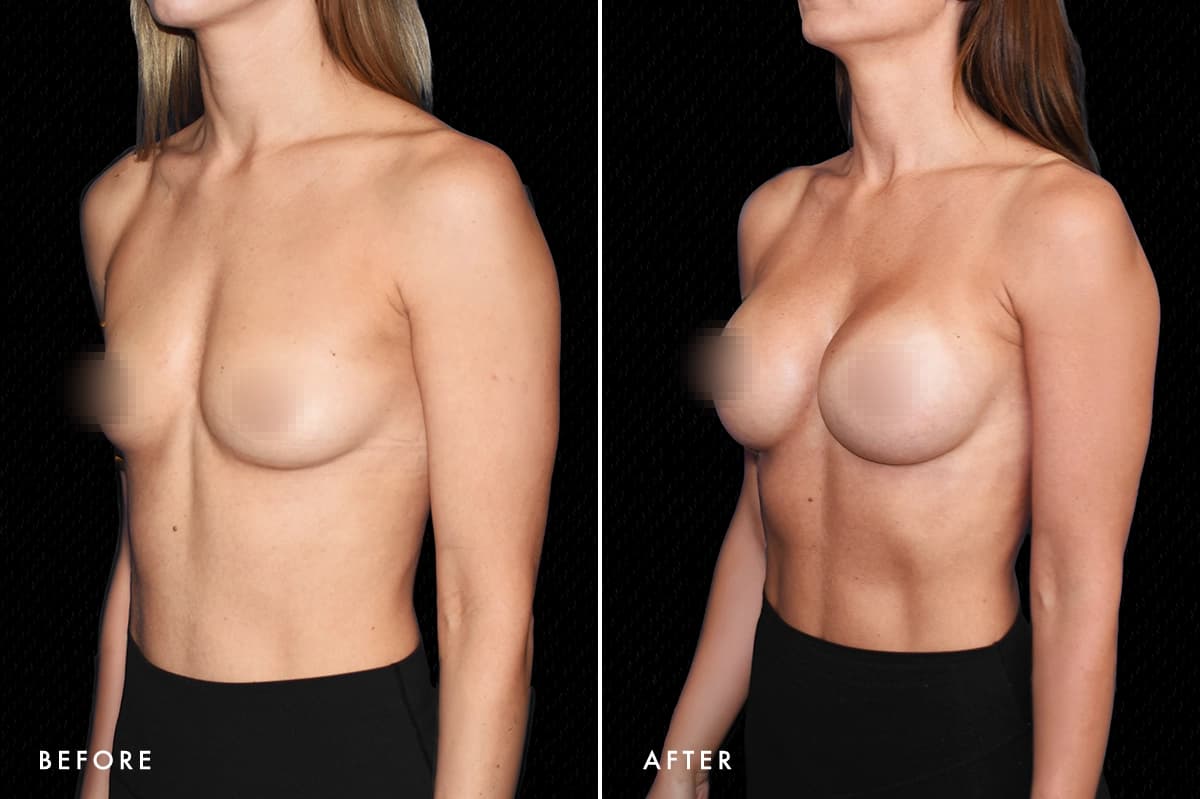 pinnacleskin.com /treatments/breast-augmentation Carousel 3 Image 8