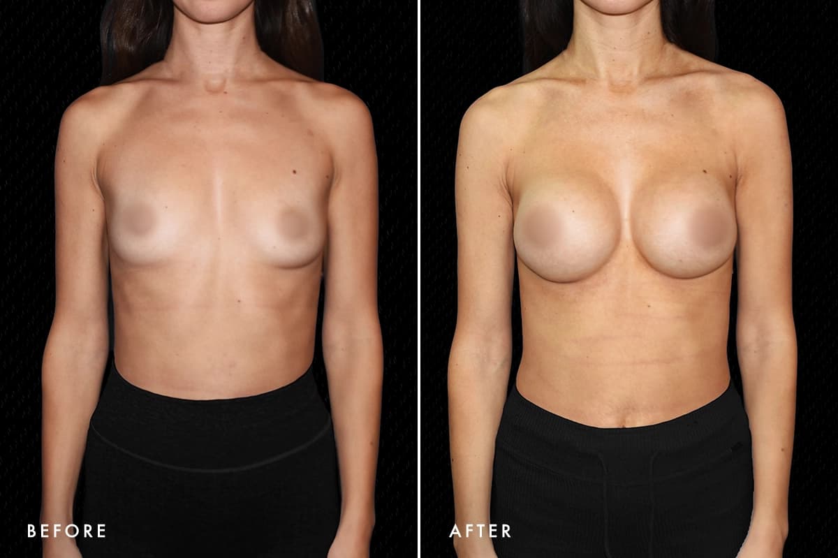 pinnacleskin.com /treatments/breast-augmentation Carousel 3 Image 4
