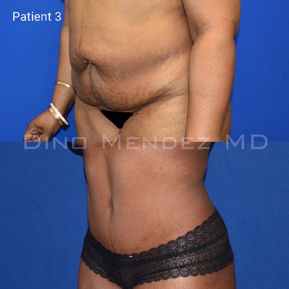 pinnacleskin.com /treatments/tummy-tuck Carousel 2 Image 6