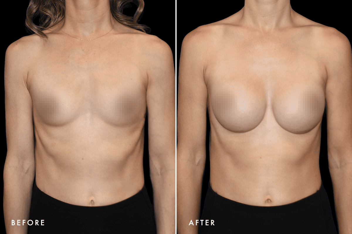 DM Ballerina Breast Augmentation B&A — Patient 3 Front