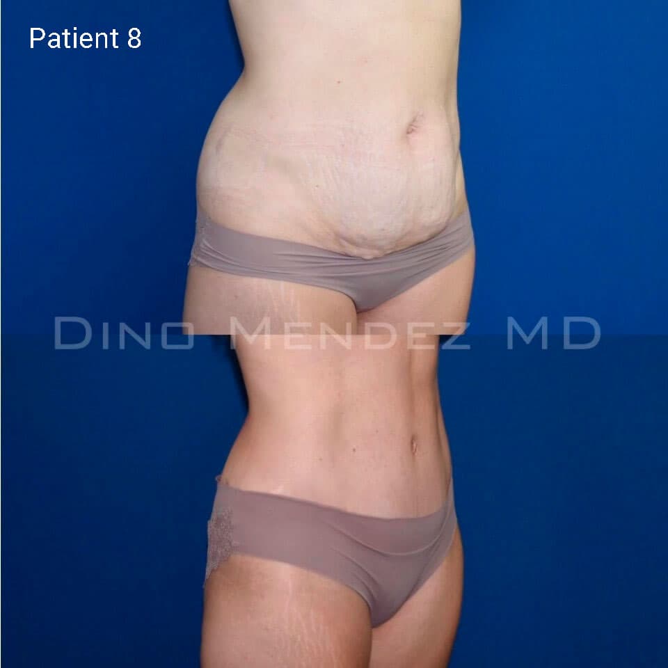 pinnacleskin.com /treatments/tummy-tuck Carousel 3 Image 6