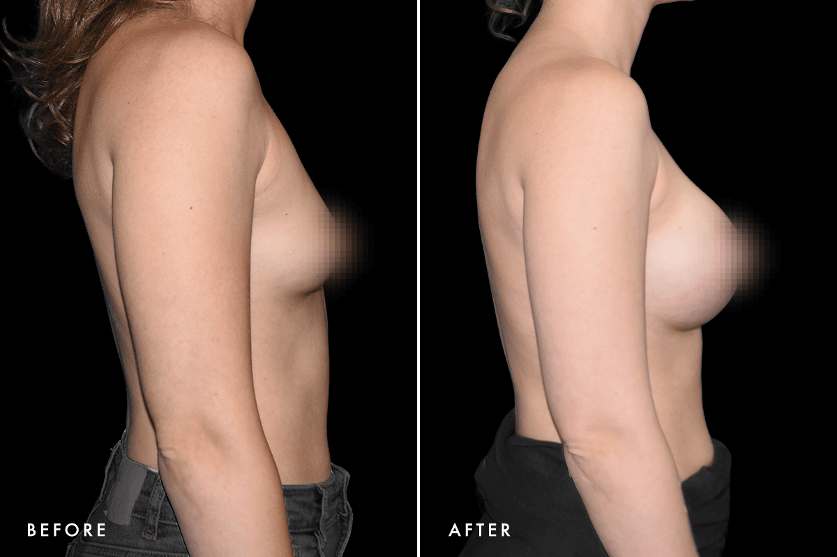 DM Breast Augmentation Gallery — Patient 5 Side