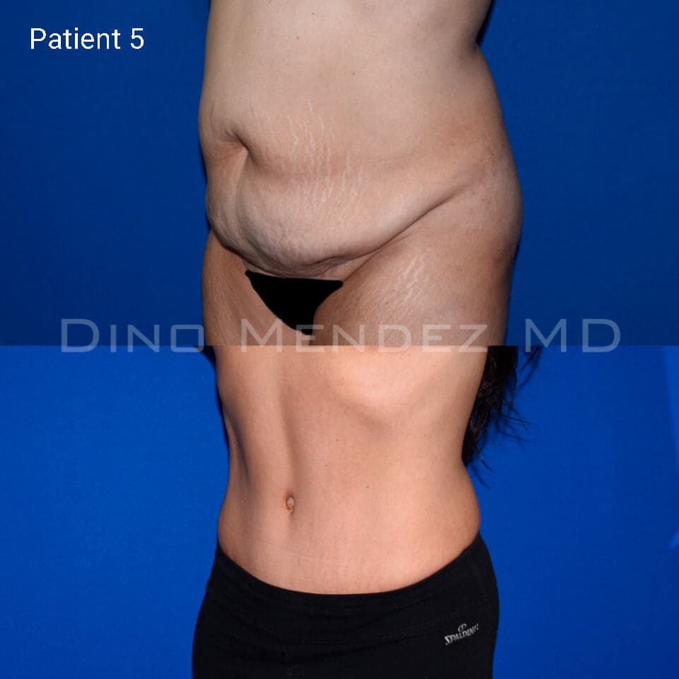 pinnacleskin.com /treatments/tummy-tuck Carousel 2 Image 9