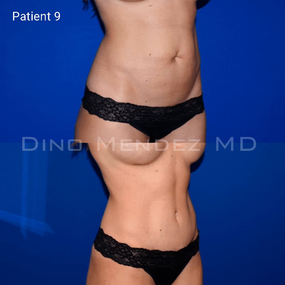 pinnacleskin.com /treatments/tummy-tuck Carousel 3 Image 8