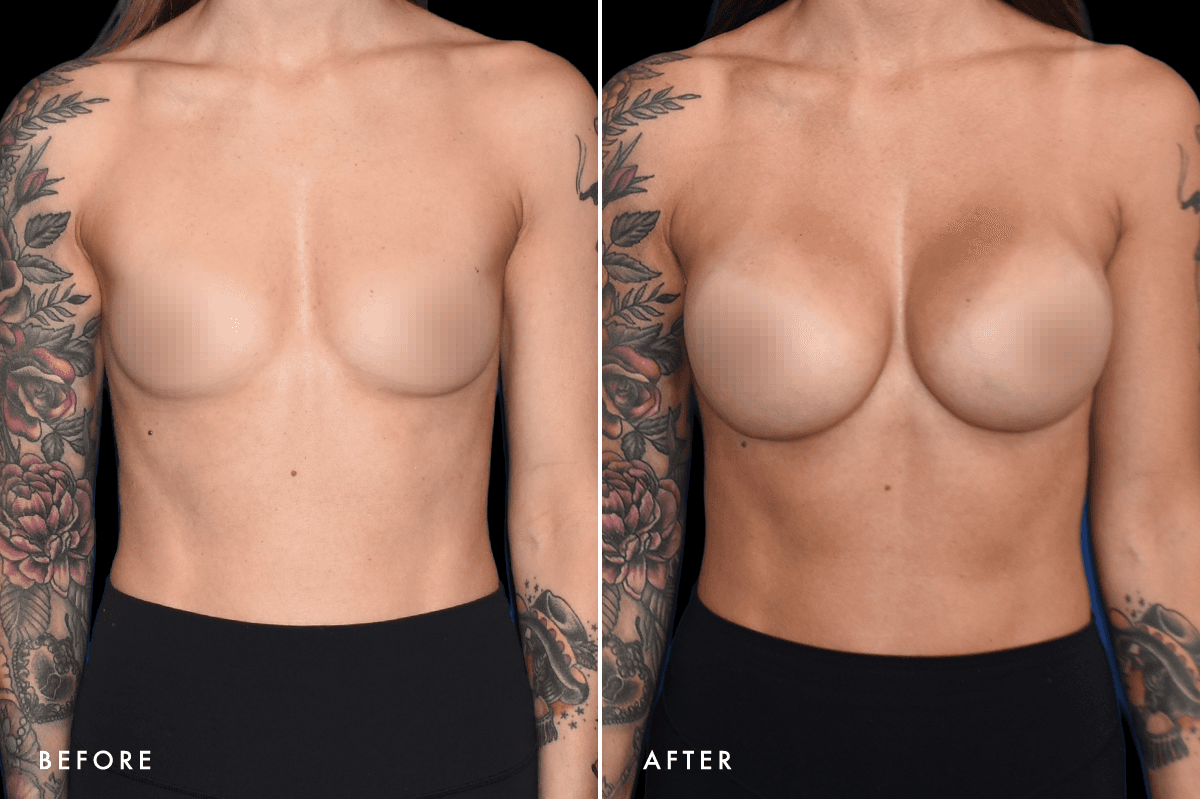 DM Breast Augmentation Gallery — Patient 3 Front