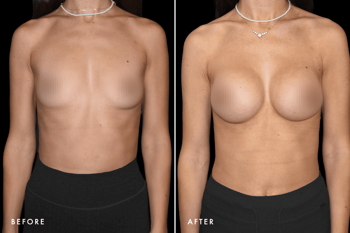 DM Breast Augmentation Gallery — Patient 7 Front