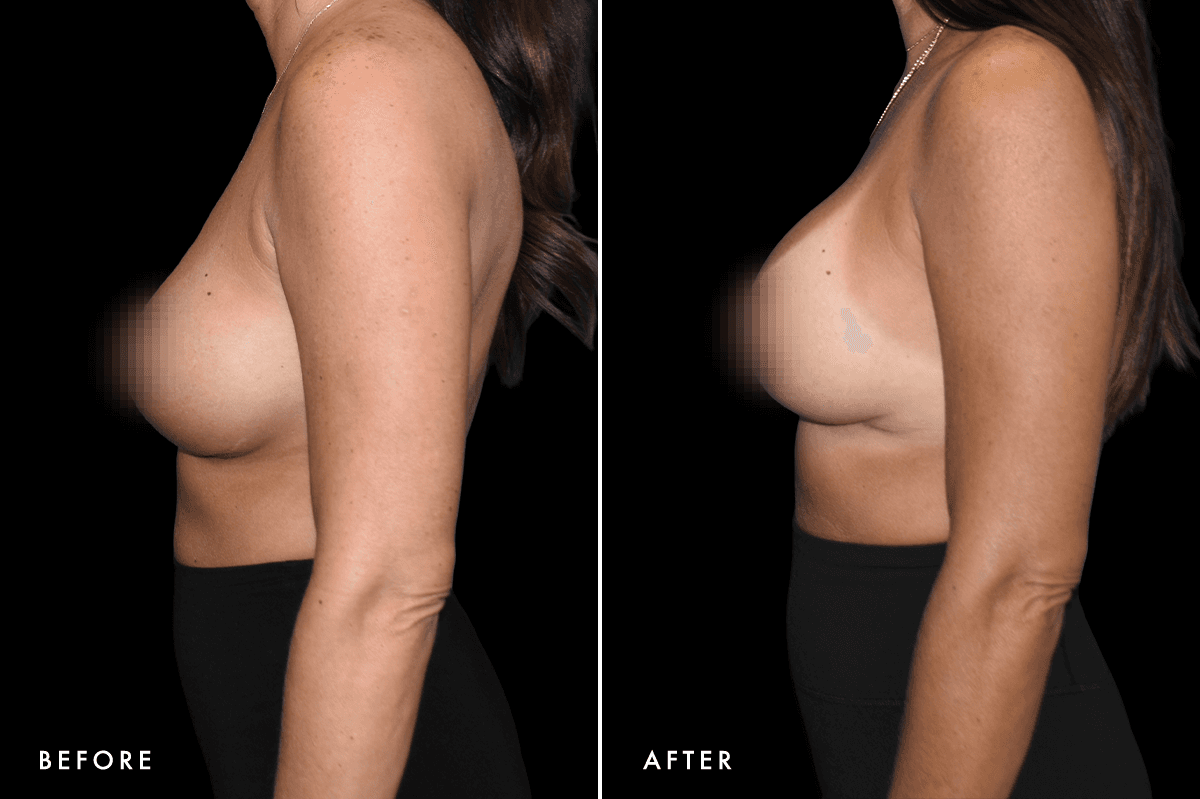 DM Capsular Contracture Correction B&A — Patient 1 Side