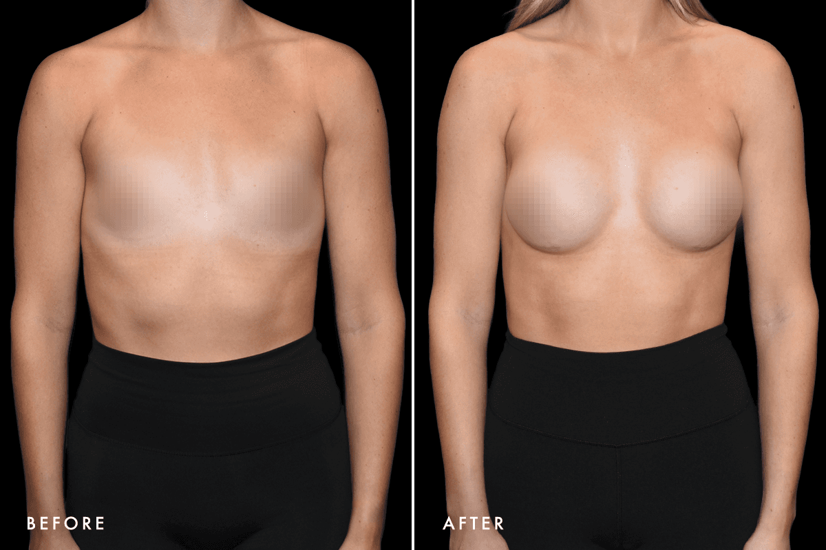 DM Breast Augmentation Gallery — Patient 10 Front
