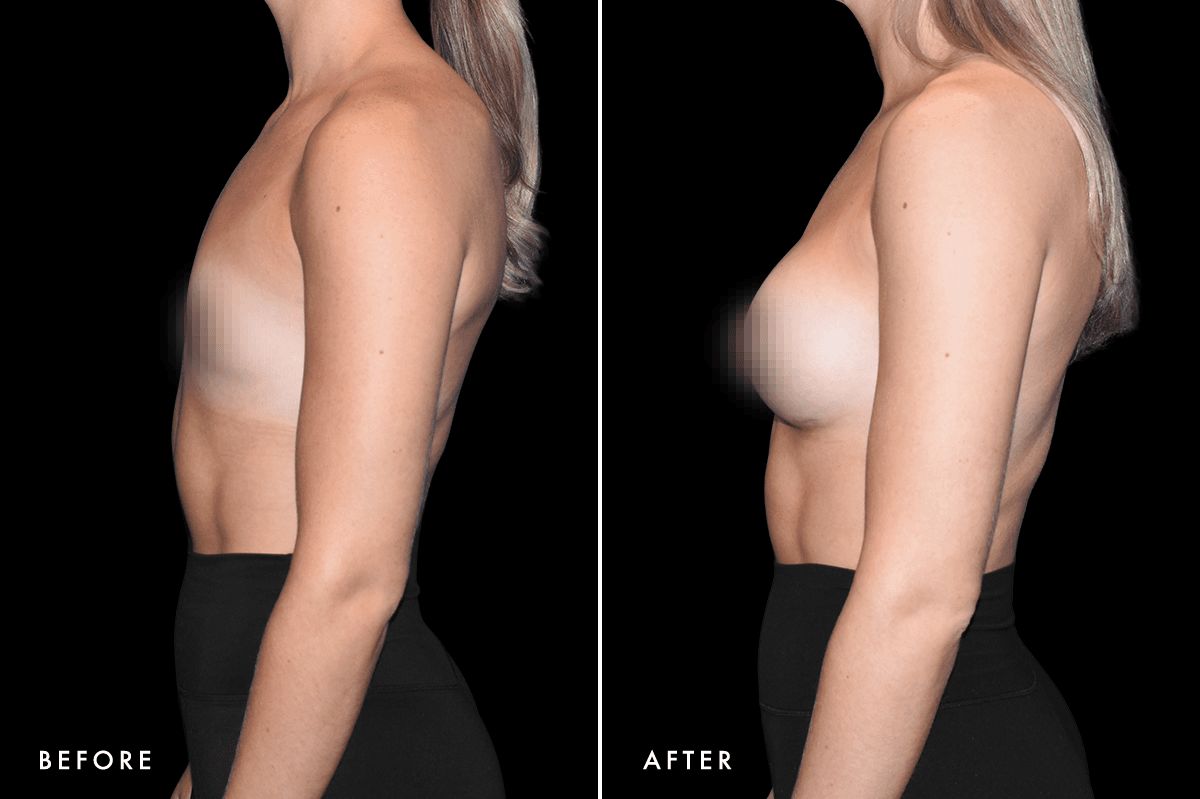 DM Breast Augmentation Gallery — Patient 10 Side