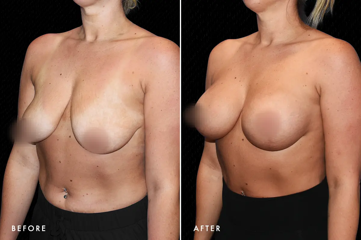 pinnacleskin.com /treatments/breast-lift Carousel 3 Image 2