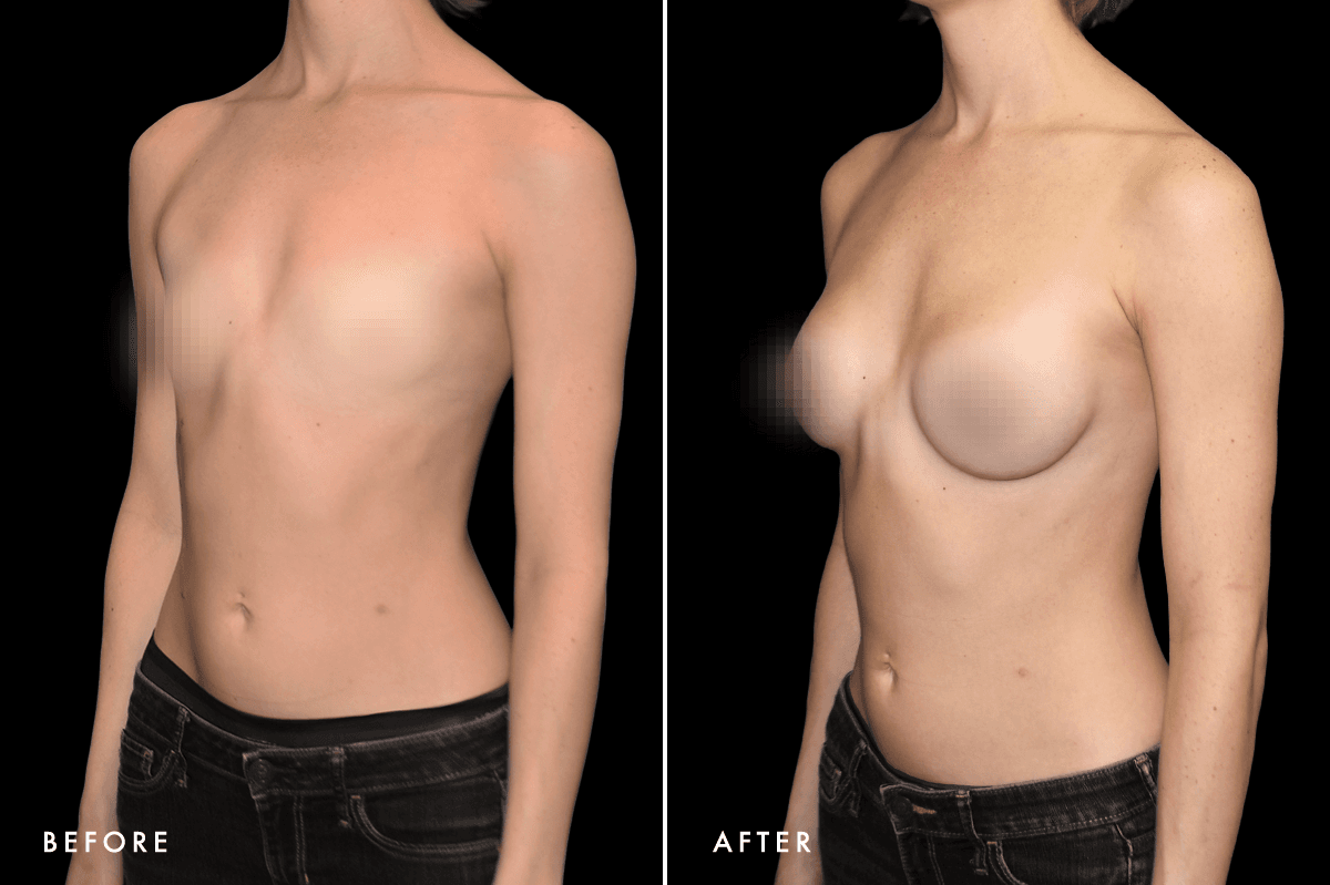 DM Ballerina Breast Augmentation B&A — Patient 2 Side