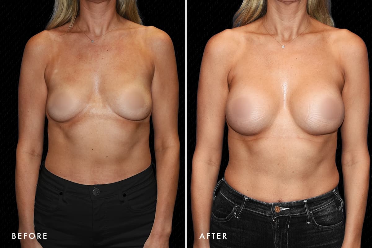 pinnacleskin.com /treatments/breast-augmentation Carousel 3 Image 1