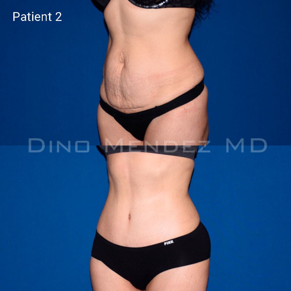 pinnacleskin.com /treatments/tummy-tuck Carousel 2 Image 4