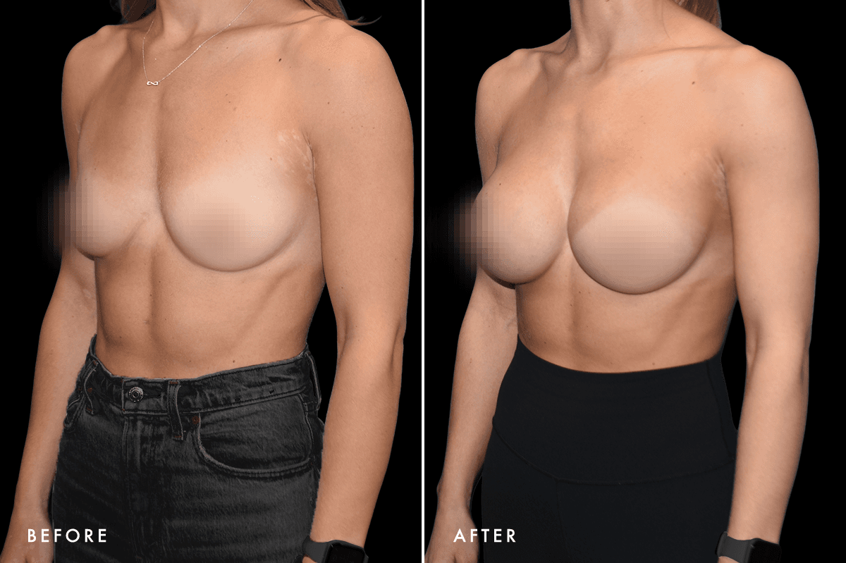 DM Breast Augmentation Gallery — Patient 4 Angle