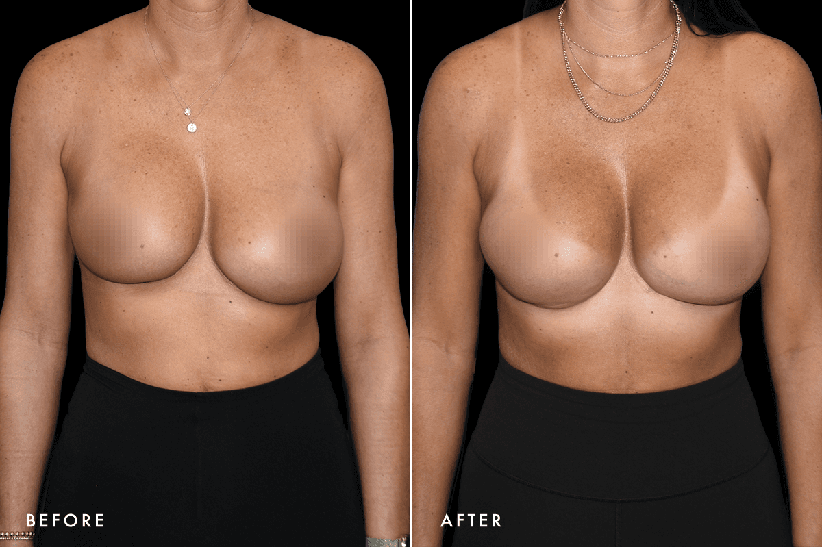 DM Capsular Contracture Correction B&A — Patient 1 Front