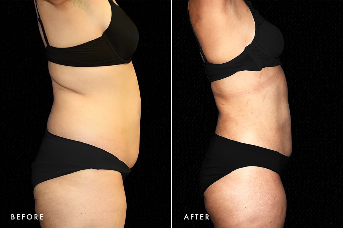 pinnacleskin.com /treatments/liposuction Carousel 1 Image 3