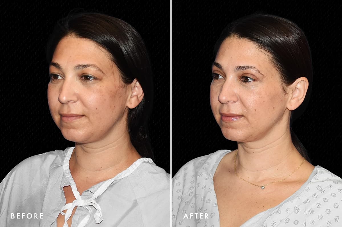 DM Upper Bleph Patient 1 Angle Before After