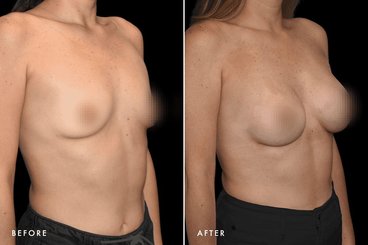 DM Breast Augmentation Gallery — Patient 6 Angle