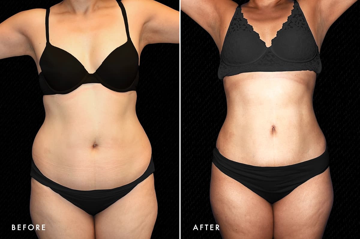 pinnacleskin.com /treatments/liposuction Carousel 1 Image 1
